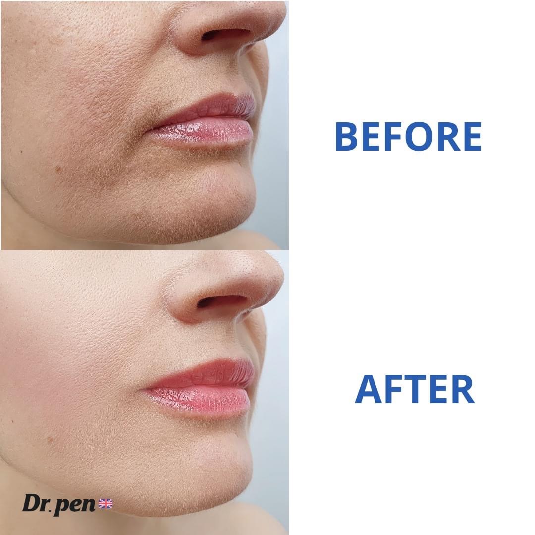 Before and after for Pen Treatment
