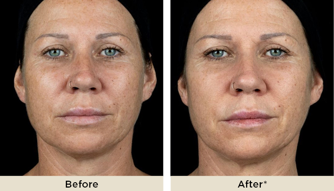 PhilArt BeforeAfter2