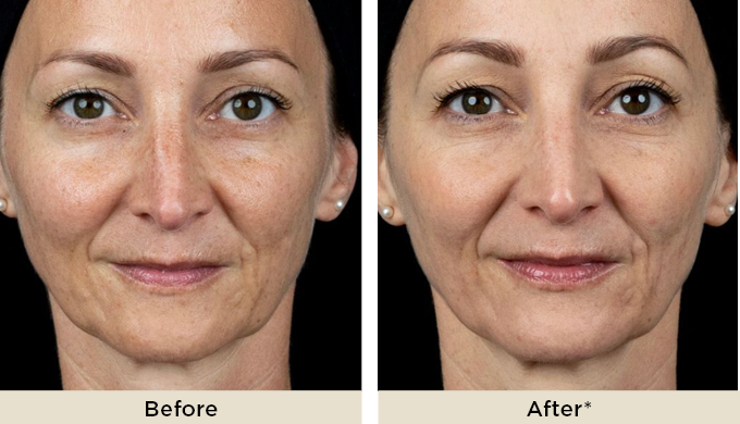 Philart BeforeAfter1