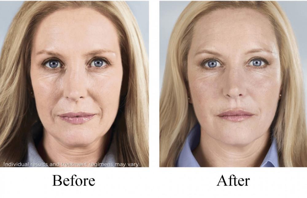 Sculptra-Before-and-After-1