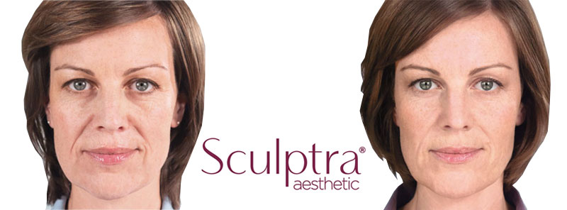 Sculptra-Before-and-After-2